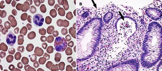 A 56-year-old man with immunoglobulin G-κ–type multiple myeloma was treated with high-dose melphalan followed by autologous hematopoietic stem cell rescue. Day 16 after transplant, he developed severe watery diarrhea and nausea. Laboratory studies showed mildly increased liver enzymes and peripheral eosinophilia (1.19 × 109/L). The differential diagnosis included drug toxicity and infectious colitis (including Clostridium difficile colitis), among other entities. However, an extensive work-up for infectious etiologies was negative, and empiric antibiotic treatment proved ineffective. Sigmoidoscopy with biopsy revealed grade 3 graft-versus-host disease (GVHD) with features of eosinophilic colitis. Peripheral blood smear showed eosinophilia (panel A). Colon biopsy showed surface epithelial erosion and crypt destruction with eosinophilic infiltration of the lamina propria and crypt lumen (panel B). The patient was treated with high-dose steroids for 1 week with significant improvement of symptoms. / GVHD is the major complication of allogeneic hematopoietic stem cell transplantation (HSCT), and is attributable to donor T-cell or natural killer cell recognition of recipient alloantigens. In autologous HSCT, there is no genetic disparity to induce an alloresponse. Occasionally, however, individuals treated with autologous HSCT (in particular, those with multiple myeloma) may develop potentially life-threatening syndromes pathologically identical to allogeneic GVHD. Peripheral eosinophilia with an associated gastrointestinal tract eosinophilic infiltrate secondary to increased levels of interleukin-2 (IL-2), IL-4, and IL-5 may be an early manifestation of autologous GVHD. Prompt recognition of this rare condition with immunosuppressive therapy is associated with improved outcomes.