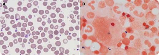 A 69-year-old man presented with a 2-year history of progressive thrombocytosis, referred to exclude essential thrombocythemia. He had been asymptomatic apart from intermittent dysphagia and a brief episode of amaurosis fugax a few weeks prior to his presentation. On examination, he had no palpable splenomegaly. Complete blood count showed the following: hemoglobin, 129 g/L; mean corpuscular volume, 85 fL; platelets, 930 × 109/L; and white blood cell count, 9.3 × 109/L. The peripheral blood smear showed marked thrombocytosis, giant platelets, and red cell dysplastic changes including oval cells, target cells, numerous red cell stippling, and Pappenheimer bodies (panel A). These findings suggested acquired sideroblastic anemia and an associated myeloproliferative neoplasm. Molecular studies showed the Janus kinase 2 V617 mutation was positive. / Bone marrow examination revealed megakaryocyte proliferation, and the megakaryocytes displayed abnormal morphology. The megakaryocytes were predominantly large, with multinucleated well-separated nuclei and abundant cytoplasm. Other hypolobulated forms were present. Erythropoiesis was mildly increased and mild dysplastic changes were evident. The Perls stain showed 30% ring sideroblasts (panel B). The reticulin stain showed a loose network of reticulin fibers (MF-1). Metaphase cytogenetic examination on the bone marrow aspirate showed a normal karyotype. / The marrow findings were consistent with the provisional entity, refractory anemia with ring sideroblasts associated with marked thrombocytosis, within the World Health Organization 2008 classification of myelodysplastic/myeloproliferative neoplasm, unclassifiable. / The presence of ring sideroblasts with the thrombocytosis helped to differentiate this neoplasm from other more common Janus kinase 2–positive myeloproliferative neoplasms that may show morphologically abnormal megakaryocytes, such as essential thrombocythemia or the prefibrotic phase of primary idiopathic myelofibrosis.