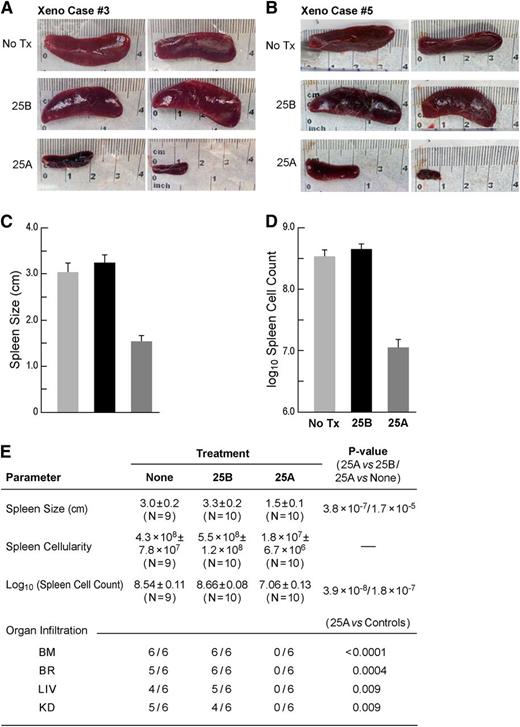 Figure 2. Treatment with 25A destroys in vivo clonogenic B-precursor ALL xenograft cells. Xenograft cells isolated from the spleens of leukemic NOD/SCID mice were treated with 25A (lipid concentration: 162 µg/mL; C61 concentration: 30 µg/mL) or 25B (lipid concentration: 162 µg/mL; C61 concentration: 0 µg/mL), or were left untreated (Tx) for 48 hours at 37°C and then reinjected into NOD/SCID mice (2 mice per group per case, 10 mice per group for all 5 cases combined). The starting cell number was identical for each treatment condition, and all mice in a given xenograft case received the same volume of cells with the same starting cell number in the inoculum. The untreated control inoculation samples in the 5 cases contained 200 000 to 400 000 cells. Experiments were terminated by the euthanasia of all mice in all treatment groups as soon as control mice showed signs of morbidity. The actual times to termination in the 5 independent experiments were 20 days, 25 days, 91 days, 112 days, and 123 days after leukemic cell inoculation. In each of the 5 independent experiments, NOD/SCID mice that were challenged with untreated or 25B-treated xenograft cells rapidly developed overt leukemia with massive splenomegaly and multiorgan infiltration. By contrast, the spleens of mice that were challenged with 25A-treated xenograft cells were much smaller and no multiorgan involvement was observed in any of the 3 cases examined histopathologically. (A-B) depict the spleens of mice from 2 representative experiments. The spleen images were obtained using an iPhone 4S equipped with an 8-megapixel iSight camera (Apple, Cupertino, CA). The cumulative data are shown in (C-D). The statistical comparisons as well as organ infiltration data are shown in (E). BM, bone marrow; BR, brain; KD, kidneys; LIV, liver.