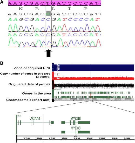 Figure 1. Mechanisms of MYD88 gene alteration. (A) Sanger sequence of MYD88 exon 5 in WM patient characterized with UPD on the 3p22 locus. The electrophoregram shows the recurrent homozygous L265P MYD88 mutation (arrow) detected in tumoral B cell of 1 patient. The reference sequence is reported in pink. (B) UPD (uniparental disomy, LOH without variation of copy number) of the short arm of chromosome 3 including MYD88 gene observed in 1 WM with MYD88 mutation using SNP array.