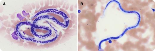 A 34-year-old man from India presented with a 1-month history of intermittent high-grade fevers, generalized weakness, and cough. The patient had a history of being treated for malaria. He was lethargic but vitally stable. Complete blood count showed thrombocytopenia with a platelet count of 71 × 109/L, a hemoglobin level of 12.3 g/dL, mild neutrophilia at 7.3 × 109/L, but no eosinophilia. Liver function tests showed mild hyperbilirubinemia with total bilirubin of 55 μmol/L. Malaria screening by the immune-chromatographic test (OptiMAL-IT; BIO-RAD, Marnes la Coquette, France) was positive for non–falciparum Plasmodium species, and thin smear demonstrated Plasmodium vivax species with a parasitemia level of 2.5%. In addition, Wuchereria bancrofti microfilariae were present (panel A). Both ring forms of P vivax and W bancrofti microfilariae are shown (panel B) (original magnification ×50). Microfilariae antigen testing was not available. The patient was treated with chloroquine followed by primaquine for 2 weeks for the malaria, and ivermectin and doxycycline for W bancrofti. / Combined malaria and filariasis should not be overlooked in patients from endemic areas, including the Indian subcontinent and central Africa. Both parasites affect the same human hosts and share common mosquito vectors. Careful evaluation of concomitant filariasis should be pursued prior to treatment. Although this can be done by antigen testing, examination of blood smears is an acceptable alternative in settings where antigen testing is not available.