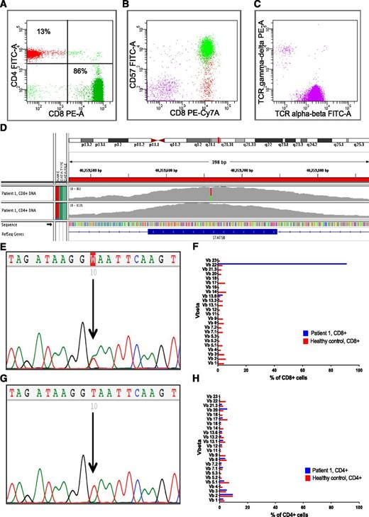 Figure 1. Sequencing and flow cytometry results of the patient 1 with STAT5b Y665F mutation. (A) The majority of the cells in the CD45-positive lymphocyte population were CD3 and CD8 positive. (B) Gated from CD3+ cells, CD8+ cells also expressed CD57 antigen and (C) TCR α-β on the cell surface. (D) IGV visualization of exon 16 of the STAT5b gene sequence. The tracks of both CD8+ tumor DNA and CD4+ control DNA are shown. In the CD8+ DNA, 30 of 73 (41%) of the reads supported the variant allele (green), and 43 of 73 (59%) the normal allele (red). In the CD4+ DNA, only the normal allele is seen (gray). (E) The mutation T>A (Y665F) in capillary sequencing of CD8+ DNA. (F) Ninety-one percent of the CD8-positive cells consisted of a single Vβ21 clone when analyzed by flow cytometry. (G) Only the normal allele T is visible in the capillary sequencing of CD4+ DNA. (H) The Vβ analysis of CD4+ cells presents normal polyclonal lymphocyte population. Y, tyrosine; F, phenylalanine; PE, phycoerythrin; FITC, fluorescein isothiocyanate; PE-Cy7, phycoerythrin-cyanine 7; T, thymidine; A, adenosine; IGV, Integrative Genomics viewer.
