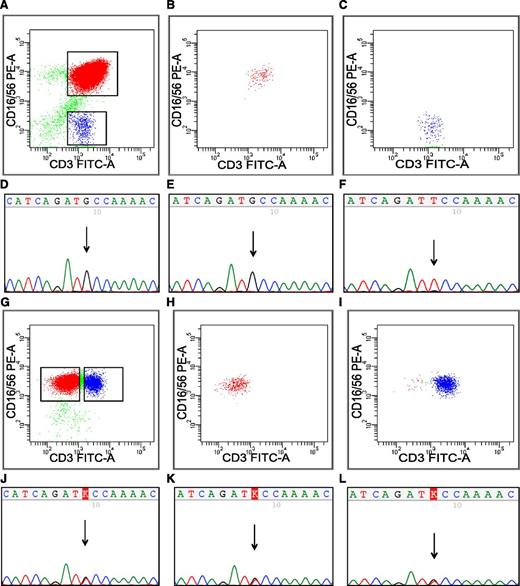 Figure 3. STAT5b sequencing from sorted fractions of patients 3 and 4. (A) In patient 3 (Table 1) with STAT5b N642H mutation, leukemic LGLs expressed CD3 and CD56. (B) Leukemic CD3+CD56+ cells and (C) CD3+CD16/56neg control cells were sorted with flow cytometry. (B-C) The purity of sorted fractions. By capillary sequencing, the mutation N642H is visible in (D) the MNC fraction and in (E) the CD3+CD16/56+ fraction, but not in (F) CD3+CD16/56neg cells. (G) The phenotype of leukemic cells in patient number 4 (Table 1) was CD3negCD16/56+ NK cell, but also CD3+ T cells aberrantly expressed CD56 antigen. Both (H) CD3negCD16/56+ and (I) CD3+CD16/56+ cells were sorted by flow cytometry, and the panels show purity of sorted fractions. By capillary sequencing, the mutation N642H was present in (J) MNCs, but also in (K-L) both of the sorted fractions, suggesting that the aberrant CD3+CD56+ cells also belong to the leukemic clone.