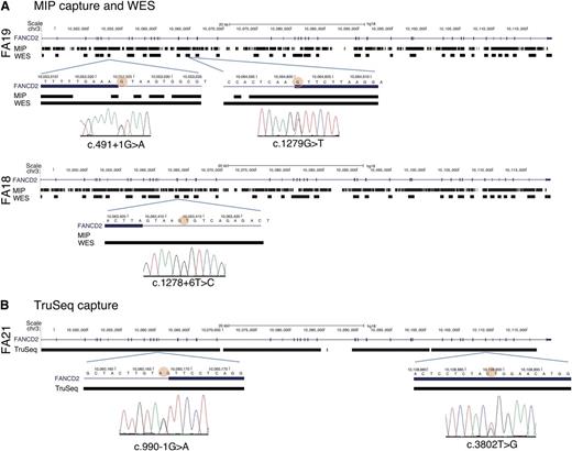 Figure 2. Evaluation of MIP, WES, and TruSeq capturing-sequencing technologies for FANCD2 mutations. (A) FANCD2 mutations identified by MIP and WES capture methods. The genotype coverage generated by the MIP and the WES methods is aligned with the FANCD2 gene track from the UCSC browser (hg18) for patients FA19 (upper panel) and FA18 (lower panel). The regions of high quality genotype coverage are indicated by solid rectangles; gaps indicate no coverage. The regions harboring the mutations are expanded below, and the circle with red shading points to the base with a mutation in the respective patient DNA. Sanger sequencing traces showing the mutations are shown below. MIP capture sequence includes the c.1279G>T location, but does not include the other mutation (c.491+G>A) for the FA19 DNA or that for the mutation in FA18. Coverage generated using the WES method, however, is nearly complete, albeit only exonic (plus immediate flanking) regions. (B) FANCD2 mutations in FA21 by TruSeq capture sequencing. The UCSC browser track for the FANCD2 gene is aligned with the genotype coverage by the TruSeq method for FA21. Sequences are recovered for nearly the entire gene. The regions harboring the mutations are expanded below (mutant base marked with red shading), along with the Sanger sequencing traces that indicate the mutations.