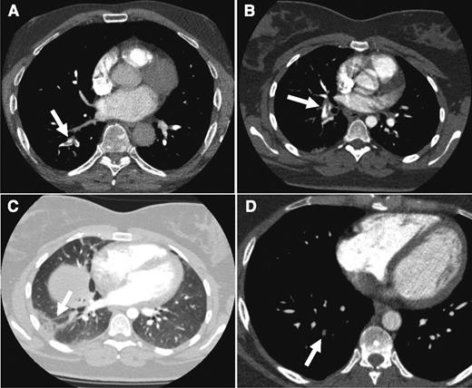 Figure 2. CTPA results from the cases. CTPA of patients from case 1 (A: arrow indicates acute thrombus in segmental artery to the right lower lobe), case 2 (B: despite breathing artifacts, clear visualization of acute PE in right segmental artery; C: arrow shows a wedge-shaped peripheral consolidation indicative of pulmonary infarction), and case 3 (D: arrow points to an organizing mural thrombus in a right basal segmental pulmonary artery).