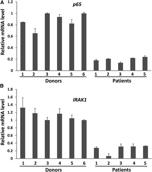 Figure 7. Downregulation of the NF-κB signaling pathway components in NK cells from lymphoma patients. (A,B) NK cells were isolated from PBMCs of both healthy donors and lymphoma patients as described in the Materials and Methods section. The purified NK cells were then immediately subjected to RNA extraction and cDNA synthesis. The expression levels of p65 (A) and IRAK1 (B) were determined by SYBR Green real-time RT-PCR assay.