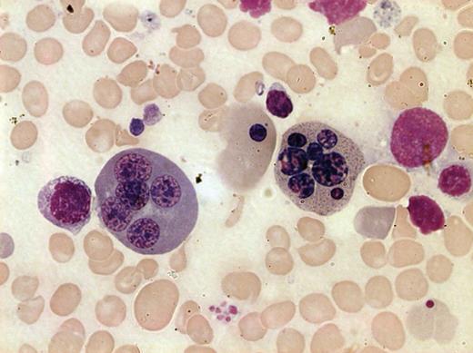 Figure 1. Bone marrow smear from a patient with CDA III. May-Grünwald-Giemsa staining was used and the image was taken by bright field microscopy with 100× objective (Leica DM3000, Leica Microsystems CMS GmbH, Wetzlar, Germany). Two polychromatic erythroblasts, 1 with 7 nuclei (right) and 1 with 5 nuclei (left) are shown. Anisocytic and hypochromatic erythrocytes are also evident.