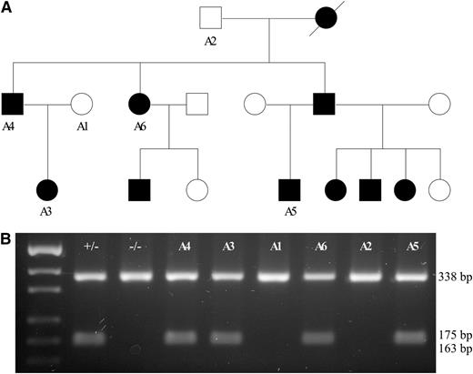 Figure 3. c.2747C>G segregates CDA III in the American family. (A) Pedigree of the family with affected individuals shown in black symbols and healthy individuals shown as unfilled symbols. DNA was available only for cases marked with A1–A6. (B) Restriction length fragment polymorphism assay. Amplification of exon 21 of KIF23 was done as described in “Materials and Methods.” PCR products were digested using the HpyCH4IV endonuclease. c.2747C>G creates a restriction site; therefore, all mutation carriers show 3 bands—338, 175, and 163 bp (small fragments are poorly resolved on agarose gel)—whereas all unaffected individuals show only 1 band (338 bp).