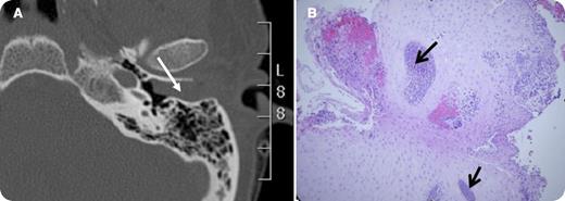 A 37-year-old woman received an allogeneic hematopoietic cell transplantation for acute promyelocytic leukemia (APL) in second complete molecular remission. She had previously received cytotoxic chemotherapy, tretinoin (ATRA), and arsenic trioxide. She presented with acute left-side hearing loss, tinnitus, and fullness. A complete blood count with peripheral smear was unremarkable. Otoscopy revealed a pale granular mass obstructing the left external auditory canal without inflammation or purulent discharge. A computed tomography scan showed that the left external auditory canal was completely occluded by a nonspecific soft tissue density (Panel A; white arrow) with no erosive osseous changes. Cultures (aerobic and anaerobic bacteria, acid-fast bacilli, fungi) were negative. Tissue biopsy of the external ear mass revealed squamous epithelium along with multifocal areas of abnormal, monomorphic cells (Panel B; black arrows; hematoxylin and eosin stain; magnification ×10) consistent with a myeloid sarcoma. Special stains (not shown) indicated that these cells were of myeloid hematopoietic lineage. Immunohistochemistry confirmed their myeloid origin (CD45+, MPO+, and CD117+). Peripheral blood was positive for the PML-RARA fusion gene. She soon developed lethal APL progression with coagulopathy. / The frequency of extramedullary relapse in APL may be increasing. This is thought to correspond with the introduction of ATRA as a component of APL therapy. ATRA stimulates expression of adhesion molecules on both APL cells and keratinocytes, potentially increasing tropism of APL cells to the skin where they proliferate.