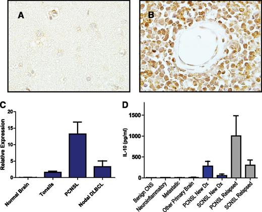 Figure 3. IL-10 expression in CNS lymphomas. Absent IL-10 expression in normal brain (A) with strong expression of IL-10 by lymphoma cells in PCNSL (B), as demonstrated by immunohistochemistry. There was weak or absent IL-10 expression by tumor vessels (×1000). (C) Quantitative RT-PCR demonstrates markedly increased expression of IL-10 in diagnostic specimens of PCNSL (N = 23) compared with reactive tonsils and specimens of normal brain. The average IL-10 transcriptional expression was also higher in PCNSL compared with 9 cases of nodal DLBCL, of which 7 were of germinal center B-cell phenotype. Notably, the normalized IL-10 transcript level, 12, in the 1 nodal activated B-cell-type DLBCL specimen was similar to the mean-normalized IL-10 expression in the PCNSL cases. (D) Mean CSF IL-10 protein is >70-fold higher in patients with both PCNSL and SCNSL compared with neuro-inflammatory conditions and other brain tumors (P < 2.3 × 10−5). The CSF concentration of IL-10 was highest in relapsed cases.