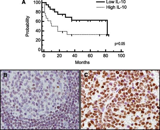 Figure 4. IL-10 is prognostic and may be associated with JAK-1 activation. (A) Patients with non-HIV–associated PCNSL and SCNSL with elevated concentration of IL-10 in CSF at diagnosis (N = 18) (above 45 pg/mL, the median concentration among all CNS lymphoma patients) exhibited significantly shorter TTP compared with patients with low CSF IL-10 (N = 21). P = .05 (hazard ratio = 2.33). The median TTP (as well as PFS) of PCNSL and SCNSL patients with low CSF IL-10 at diagnosis is 82 months vs 10 months for patients with elevated CSF IL-10. The median OS of CNS lymphoma patients with low CSF IL-10 at diagnosis was 84 months, whereas the median OS of patients with elevated CSF IL-10 at diagnosis has not been reached. P < .057 (hazard ratio = 3.6) (not shown). All patients were treated with a high-dose methotrexate-based induction regimen without whole brain irradiation consolidation. Patients with stage IV DLBCL with CNS involvement received cyclophosphamide, vincristine, adriamycin, and prednisone instead of temozolomide, as described.27 Germinal center B cells in reactive tonsils (B) exhibited weak to absent immunoreactivity for JAK-1 activation (phosphorylation of JAK-1 at tyrosine 1022), whereas strong intratumoral JAK-1 activation (>30% lymphoma cells) was detected in 70% of diagnostic specimens of PCNSL (N = 30) (C) (×1000).