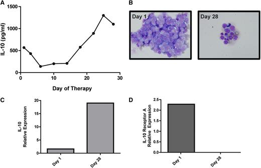 Figure 5. IL-10 gene expression and CSF concentration correlate with disease course in a patient with recurrent CNS lymphoma. (A) A decline in CSF concentration of IL-10 correlates with initial cytological response followed by tumor progression in a representative patient with recurrent SCNSL who participated in a phase 1 trial of intraventricular rituximab plus methotrexate.30 (The result is representative of 6 consecutive trial patients analyzed.) (B) Cytological appearance of lymphoma cells in CSF at baseline and persistent disease at completion of intraventricular therapy (28 days). (C) Quantitative RT-PCR of RNA transcripts purified from B cells isolated from the CSF by flow cytometry demonstrated upregulated IL-10 expression in refractory CNS lymphoma after treatment with rituximab plus methotrexate. The increased relative expression of IL-10 transcripts by the meningeal lymphoma cells corresponded to increased concentration of IL-10 protein in CSF at day 28 (A). (D) In contrast, transcriptional expression of IL-10 receptor A decreased after therapy.