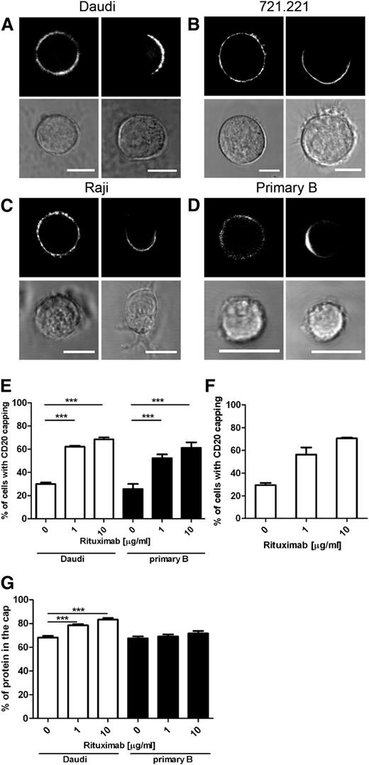 Figure 1. Rituximab enhances capping of CD20 on the B-cell surface. Fluorescent and bright-field images of B-cell lines Daudi (A), 721.221 (B), and Raji (C) expressing CD20-GFP or primary B cells (D) untreated or incubated with 10 μg/mL rituximab (left and right panels, respectively). Primary B cells were additionally labeled with anti–CD20-AF647 antibody recognizing the intracellular portion of the protein. Scale bars represent 10 μm. (E) Capping of CD20 was quantified on images of Daudi/CD20-GFP and primary B cells incubated in the absence or presence of 1 μg/mL and 10 μg/mL rituximab. Graph represents mean ± SEM of 3 independent experiments. (F) Capping of CD20 in Daudi/CD20-GFP cells was quantified by flow microscopy. Cells were incubated alone or with 1 μg/mL or 10 μg/mL rituximab and then fixed and analyzed by the ImageStream multispectral imaging flow cytometer. Graph represents mean ± SEM of 2 independent experiments. (G) Quantification of the fraction of CD20 localized in the cap in Daudi/CD20-GFP and primary B cells. A total of 30 to 32 cells were analyzed per condition. Data were analyzed by 1-way ANOVA with Bonferroni post-test. ***P < .001.