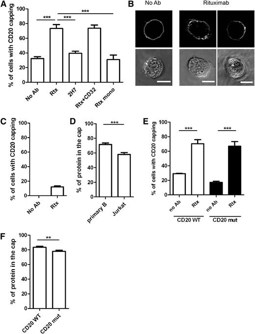 Figure 2. Enhancement of CD20 capping is specific for rituximab and B cells. (A) Daudi/CD20-GFP cells were incubated alone; or in the presence of 10 μg/mL rituximab (Rtx) or 10 μg/mL mouse CD20-targeting antibody 2H7; or preincubated with 20 µg/mL CD32-blocking antibody followed by incubation with 10 μg/mL rituximab (Rtx+CD32); or incubated with 20 μg/mL of a monovalent version of rituximab (Rtx mono). Number of cells with polarization of CD20 was scored. Graph represents mean ± SEM of 3 independent experiments. More than 160 cells were analyzed per condition. (B) Fluorescent and bright-field images of Jurkat/CD20-GFP cells untreated (left panels) or incubated with 10 μg/mL rituximab with uniform distribution of CD20 or CD20 capped on 1 side (middle and right panels, respectively). (C) Capping of CD20 was quantified on images of Jurkat/CD20-GFP cells incubated in the absence or presence of 10 μg/mL rituximab. Graph represents mean ± SEM of 3 independent experiments. A total of 112 to 118 cells were analyzed per condition. (D) Amount of CD20 accumulated in the cap in Jurkat/CD20-GFP cells pretreated with 10 μg/mL rituximab was compared with the amount of CD20 accumulated in the cap in primary B cells pretreated with 10 μg/mL rituximab. Data were analyzed by unpaired t test (2-tailed). A total of 21 to 31 cells from 3 or 4 experiments were analyzed per condition. (E) Daudi/CD20-GFP (CD20 WT) or Daudi cells expressing a mutant form of CD20-GFP (CD20 mut) were left untreated or incubated with rituximab and then fixed and analyzed by laser scanning confocal microscopy. The proportion of cells with polarized CD20 is shown. Graph represents mean ± SEM of 3 independent experiments. Data were analyzed by unpaired t test (2-tailed). More than 200 cells were analyzed per condition. (F) The amount of CD20 accumulated in the cap in Daudi cells expressing a mutant form of CD20-GFP (CD20 mut) pretreated with 10 μg/mL rituximab was compared with the amount of CD20 accumulated in the cap in Daudi/CD20-GFP (CD20 WT) cells pretreated with 10 μg/mL rituximab. A total of 31 cells from 2 or 3 experiments were analyzed per condition. Data were analyzed by unpaired t test (2-tailed). **P < .01; ***P < .001. Ab, antibody.