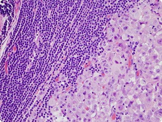 A 39-year-old man noted a pigmented lesion on his back that had been growing for ∼1 year. A punch biopsy demonstrated malignant melanoma, nodular type. He was also found to have a white blood cell count of 45.8 × 103/μL and palpable axillary, cervical, and inguinal lymph nodes. The blood was sent for flow cytometry and demonstrated a population of small CD19+ B cells that were λ light chain restricted, CD5+, CD10−, and CD23+ consistent with chronic lymphocytic leukemia/small lymphocytic lymphoma (CLL/SLL). Surgical pathology received bilateral axillary contents and a wide excision of the melanoma on the back. The lymph nodes grossly demonstrated areas that were pink-tan and fish-fleshy and other areas that were darkly pigmented. Of the 84 lymph nodes that were microscopically evaluated, 43 were involved by melanoma, and all were involved by CLL/SLL. / This case demonstrates an unusual circumstance of 2 primary malignancies present in the same specimen. Interestingly, BRAF mutations have been reported in both malignancies. Testing for BRAF mutations was performed on the punch biopsy and a bone marrow biopsy involved by CLL/SLL. The punch biopsy demonstrated a V600K BRAF mutation; however, a BRAF mutation was not detected in the bone marrow biopsy.