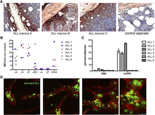 Figure 1. Human ALL blasts express high levels of OPN when localized to the endosteal niche, express OPN receptors, and adhere to tcOPN in vitro. (A) Representative micrographs of OPN IHC analysis of BM biopsies from control patients and patients with pre-B ALL. Leukemic lymphoblasts were found to express OPN in 6 of 6 ALL cases examined, and representative images are shown of 3 ALL cases and 1 control case. A gradient of OPN expression was detected in the leukemic marrows, with high OPN-expressing blasts localized near the trabecular bone surfaces. (B) Flow cytometry analysis of 6 primary ALL samples demonstrating variable expression of known OPN receptors. (C) In vitro adhesion assay to tcOPN of the 6 primary ALL samples from (B) demonstrating significant adhesion to OPN of blasts isolated from patients 1 to 3. (D) Intravital confocal imaging of the calvarial marrow of mice engrafted with DiR-labeled primary ALL cells (ALL #3 from Figure 1B-C). Mice were engrafted 42 days before imaging. Dormant DiR-retaining cells are represented in green; extracellular OPN is represented in red. The far right panel is a magnification of panel 3. A significant portion of dye-retaining blasts was found co-localized with or adjacent to areas of high OPN expression (n = 3).