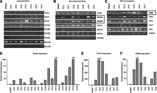 Figure 4. Wnt gene profiling demonstrates elevated expression of Wnt5a in ATL patient samples. (A-C) PCR amplification of typical canonical Wnts (A), noncanonical Wnts (B), and their coreceptors (C) from cDNA derived from ATL patient samples. R.PBMCs were used as controls. GAPDH amplification in nonsaturating conditions served as a control for the quality and quantity of the samples. Open boxes highlight genes differentially expressed between R.PBMCs and ATL patients. (D-F) Real-time PCR analysis of Wnt5a, PTHLH, and RANKL expression from cDNA derived from ATL patients. Samples were normalized to GAPDH expression and the fold change was calculated by comparing values to R.PBMCs normalized gene expression.