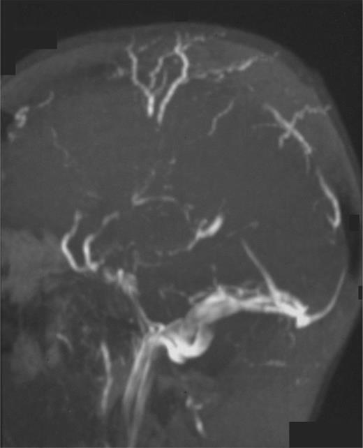 Figure 1. Magnetic resonance angiography in a patient with PNH and superior sagittal sinus thrombosis with collateral vessel formation.