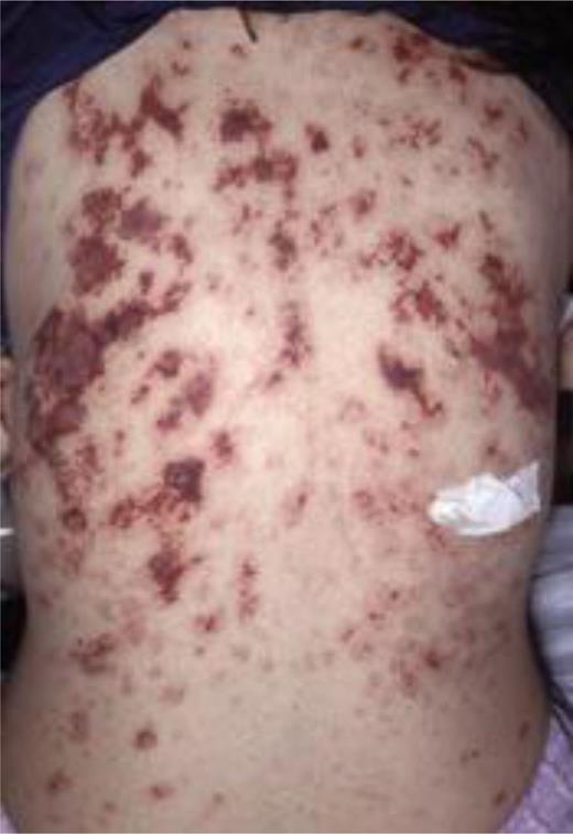 Figure 2. Case of dermal vein thromboses in a patient known to have PNH. (Reproduced with permission from Watt SG, Winhoven S, Hay CR, Lucas GS. Purpura fulminans in PNH. Br J Haematol. 2007;137:271.)