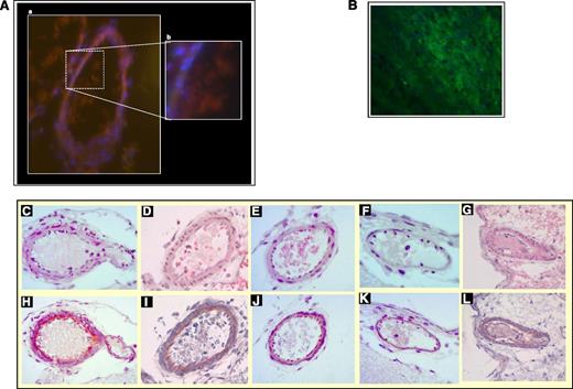 Figure 5. MCA thrombosis. (A) Representative images of an occluding MCA thrombus formed in vehicle-treated guinea pigs at immunofluorescence. Sections of frozen brains were cut and stained for a platelet marker (CD41, red) and fibrinogen/fibrin (green) and were counterstained for nuclei (blue): thrombus is mainly formed by platelets with only minor presence of fibrin (A, Magnification ×20; B, Magnification ×100). (B) Positive control for fibrin: a thrombus obtained in the stenosis-induced deep venous thrombosis model was longitudinally cut and stained for fibrinogen/fibrin (green) and counterstained for nuclei (blue). Magnification ×100. A Zeiss Axiovert 200 inverted fluorescence microscope (objectives: Zeiss Plan-Apochromate 10×/0.45 or 63×/1.4) connected to a monochrome camera (AxioCam MRm) was used for imaging. Colors for fluorescent channels were assigned by using Axiovision software (Axio Vs 40, Version 4.6.3.0). (C-L) Representative histologic micrographs of MCA thrombus of guinea pigs treated with vehicle and ALX-0081 at 5 mg/kg after photochemical-induced thrombosis. Slides were stained with hematoxylin and eosin for cellular components (top row), or phosphotungstic acid for fibrin (bottom row). (C,H) Vehicle-treated guinea pigs (brains collected immediately after the complete occlusion of MCA). (D,I) Vehicle-treated guinea pigs (brains collected 1 hour after the complete occlusion of MCA). (E,J) ALX-0081 administered at the moment of complete occlusion. (F,K) ALX-0081 administered 15 minutes after occlusion. (G,L) ALX-0081 administered 60 minutes after occlusion. Sections were analyzed by optical microscopy (Leica; Wetzler, Germany) using ×40 magnification.