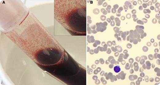 A 72-year-old woman presented to the emergency room with acute onset adynamia and tachycardia. On physical examination, icterus and splenomegalia were noted. The first blood specimens could not be analyzed because of the rapid clotting of all samples in the blood tubes at room temperature. After placing drawn blood samples in a warm water bath, clotting occurred in the upper part of the tube not fully immersed in water, but the warmed part remained fluid (panel A). Blood samples were brought to the laboratory in a warmed container, and analysis revealed a hemoglobin value of 4.2 g/dL (normal, 12.0-16.0 g/dL). Red cell count was 1.49 million/µL (normal, 4.2-6.2 million/µL). The Coombs test was positive for red cells coated with C3dg only (and therefore positive with only anti-C), and monoclonal immunoglobulin M-κ was present. Clots of erythrocytes were also visible on blood smears done at room temperature (May-Grünwald staining; panel B). Cold agglutinin disease was suspected and confirmed by increased cold agglutinin titer. After prewarmed blood transfusion via an infusion warmer, the patient’s condition improved. / In our experience, macroscopically visible blood clotting occurs in very high cold agglutinin titers (ie, >1:2000). Therefore, careful inspection of the blood tubes for agglutination can be helpful for the rapid diagnostic approach to anemia. This can be especially important in an emergency setting.