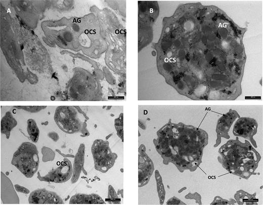 Figure 5. Transmission electron microscopy of platelets. Magnification ×25 000 (A,B) and 8800 (C,D). A and C depict patient platelets and B and D depict control. Shown are decreased alpha-granule (AG) content and distorted open channel system (OCS) in patient platelets when compared to control.