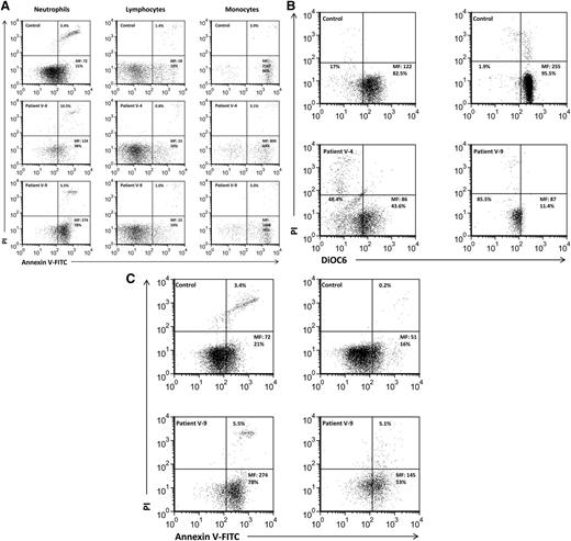 Figure 6. Accelerated apoptosis in patients’ neutrophils. (A) Freshly isolated neutrophils, monocytes, and lymphocytes were stained for annexin V expression and PI admission. Mean fluorescence (MF) and the percentage of positive cells are indicated. These are representative examples of the samples summarized in Table 2. These are representative examples of the samples summarized in Table 2. (B). Mitochondrial permeability transition evaluation in neutrophils is shown. Neutrophils were resuspended with 0.3 mL RPMI and loaded with 1.75 nM DiOC6 for 15 minutes at 37°C. Cells were then transferred to 2°C to 8°C, stained with PI for 10 minutes, and analyzed by flow cytometry. MF and the percentage of gated cells are shown. The left lower quadrant includes cells that lost mitochondrial potential (apoptotic cells). (C) Accelerated constitutive spontaneous neutrophil apoptosis is shown. Freshly isolated neutrophils were either immediately evaluated (right) or harvested after 4 hours of spontaneous constitutive apoptosis (left). MF is indicated for annexin, and the percentage of PI-positive cells is also indicated.