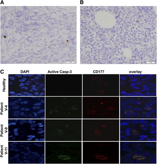 Figure 7. Increased apoptosis in bone marrow. (A) Immunostaining of activated caspase-3 in the bone marrow showed markedly increased apoptosis. The image is representative of 3 patients. (B) Similarly stained normal bone marrow of a patient of the same age is shown. A biopsy was obtained from a patient with Wilms tumor in order to assess the presence of metastases. (C) Increased apoptosis of granulocytes in the bone marrow of patients with mutated VPS45 patients is shown. Bone marrow sections of a healthy person and 3 patients with VPS45 mutations were co-immunostained with specific antibodies against activated caspase-3 (green) and CD177 (red). DNA was counterstained using DAPI.