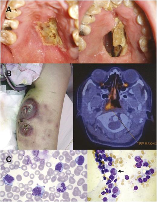 Figure 1. Different clinical forms of NK/T-cell lymphomas. (A) Nasal lymphoma showing an initial ulcer (left) that ultimately perforated into the oral cavity, creating a communication between the oral cavity and the nasal cavity. In the past, such a lesion was referred to as “lethal midline granuloma.” (B) Lymphoma initially localized to the calf, presenting as nonhealing ulcers. PET/CT showed occult nasal involvement. This case could be erroneously classified as “nonnasal” lymphoma. (C) Aggressive NK-cell leukemia showing neoplastic cells that were large granular lymphocyte in morphology in the peripheral blood and in the bone marrow (arrow).
