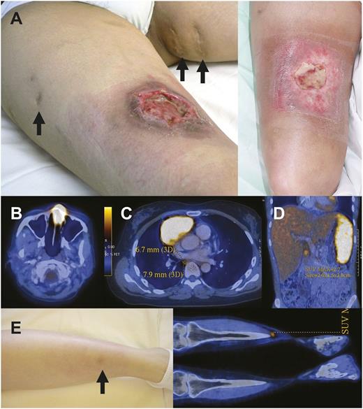 Figure 2. Clinical images of NK/T-cell lymphoma. (A) A large ulcer that on biopsy showed NK/T-cell lymphoma. Scars (arrows) were attributed by the patient to be due to ulcers that healed from previous mosquito bite hypersensitivity, occurring over a period of decades. There was almost complete healing of the ulcer after 2 courses of SMILE (right side). (B) Typical PET/CT image of a nasal lymphoma. (C) Relapse of nasal NK/T-cell lymphoma in the mediastinum. (D) Disseminated NK-cell lymphoma showing diffuse splenic uptake. (E) Relapsed cutaneous NK/T-cell lymphoma. The lesion was very subtle and showed up on PET/CT with a low SUVmax. This patient presented with multiple skin lesions.