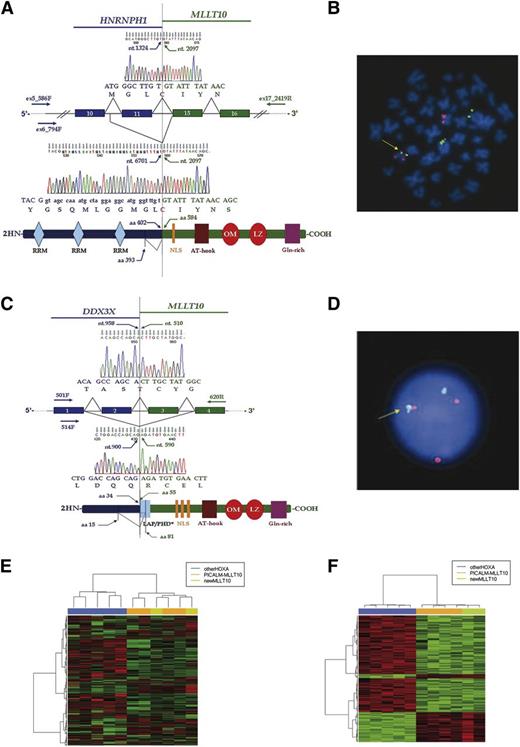 Figure 1. Molecular characterization of the two new MLLT10 fusions. (A) Two HNRNPH1-MLLT10 splicing isoforms were identified in patient 1. (Top) Direct sequencing showed an in-frame HNRNPH1-MLLT10 isoform joining nucleotide 1324 (HNRNPH1 exon 11) to nucleotide 2097 (MLLT10 exon 15). (Bottom) Cloning and sequencing showed nucleotide 6701 (HNRNPH1 intron 10) fused in-frame with nucleotide 2097 (MLLT10 exon 15). Hypothetical fusion protein was shown in which HNRNPH1 maintained all 3 RRM at the N terminus and MLLT10 lost 2 of 3 NLS. MLLT10 maintained the critical OM-LZ domain at the C terminus. Primer and sequence numbers refer to GenBank accession NC_000005.9, NM_005520.2, NP_005511.1 for HNRNPH1 and NM_004641.3, NP_004632.1 for MLLT10. (B) DCDF test: Probes for MLLT10 (RP11-418C1 and RP11-249M6) in orange and for HNRNPH1 (CTD-3223H16 and RP11-410B18) in green showed 1 fusion signal on der(10) (arrow). (C) Two DDX3X-MLLT10 splicing isoforms were identified in patient 2. (Top) Sequencing showed an in-frame DDX3X-MLLT10 isoform joining nucleotide 958 (DDX3X exon 2) to nucleotide 510 (MLLT10 exon 3). (Bottom) Cloning and sequencing showed an in-frame isoform with nucleotide 900 (DDX3X exon 1) fused with nucleotide 590 (MLLT10 exon 4). The hypothetical fusion protein lost the DDX3X DEAD box domain at the N terminus and maintained part of the PHD, all 3 NLS and the OM-LZ domain at the C terminus. Primer and sequence numbers refer to GenBank accession NM_001356.3, NP_001347.3 for DDX3X and NM_004641.3, NP_004632.1 for MLLT10. (D) DCDF-FISH with probes for DDX3X in green (RP11-1058N11, flanking 5′, and RP11-10K13, flanking 3′) and MLLT10 in red (RP11-418C1 and RP11-249M6), showed 1 fusion signal (arrow). (E) Unsupervised analysis of 11 T-ALL HOXA patients. In such unsupervised analysis, patients bearing MLLT10 rearrangements and those without MLLT10 rearrangements (1 MLL-ENL, 1 MLL-AF6, 2 TCRB-HOXA, and 1 SET-NUP214) are naturally clustered in 2 distinct groups. PICALM-MLLT10 patients are indicated in orange; patient 1 and patient 2 (HNRNPH1-MLLT10, DDX3X-MLLT10) in green and patients without MLLT10 rearrangements in blue. (F) Supervised analysis was created using the significative probe sets from the comparison of HOXA patients with MLLT10 rearrangements (4 with PICALM-MLLT10 and the 2 new cases with HNRNPH1-MLLT10, DDX3X-MLLT10) vs patients without MLLT10 rearrangements (1 MLL-ENL, 1 MLL-AF6, 2 TCRB-HOXA, and 1 SET-NUP214). Patients bearing MLLT10 recombinations are indicated in orange or green while patients without MLLT10 rearrangements are indicated in blue. DCDF, double-color double-fusion; LAP, Leukemia Associated Protein; NLS, nuclear localization signal; PHD, plant homeo domain; RRM, RNA recognition motif.