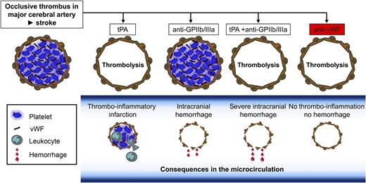 Inhibition of the GPIb-vWF axis exerts thrombolytic effects and prevents stroke progression in the absence of intracranial bleeding. Ischemic stroke is mainly caused by thromboembolic occlusion of a major cerebral artery (top panel, left). Treatment with tPA leads to recanalization of the occluded macrovessel, but in the study by Momi et al,1 it did not prevent thrombo-inflammation in the microcirculation and further stroke progression. Inhibition of platelet GPIIb/IIIa (top panel, anti-GPIIb/IIIa) has no thrombolytic effect but causes intracranial hemorrhage, which is even worse when given in combination with tPA (tPA + anti-GPIIb/IIIa). In sharp contrast, inhibition of the GPIb-vWF axis induces thrombolysis at early time points after thrombus formation and prevents thrombo-inflammatory damage of the microcirculation and infarct progression (top panel, right). The latter effect is even seen at later time points when the thrombolytic effect is lost due to thrombus stabilization (not shown).