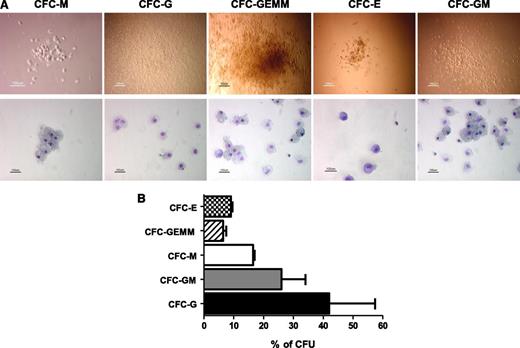 Figure 2. iPS-HPCs differentiate into multilineage progenitors. (A) To determine the multilineage potential of iPS-HPCs, HPCs were used to form CFUs. The upper panel shows the morphology of the CFUs, and the lower panel shows the CFUs after staining with Giemsa-Wright solution. These CFUs are similar to those formed by human bone marrow stem cells. (B) Relative percentages of CFU-E, -GEMM, -M, -GM, and -G. CFU-G shows the highest frequency. CFU-E and CFU-GEMM showed the lowest frequency (mean ± SD).