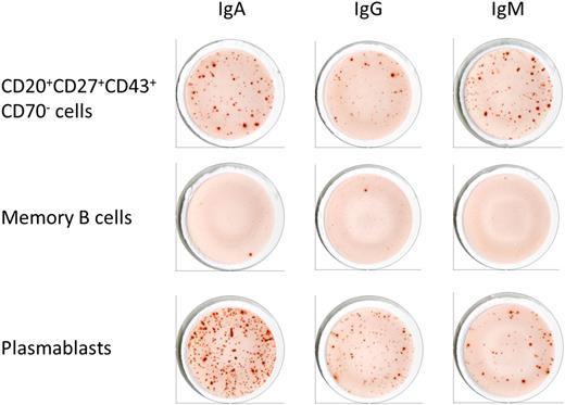 Figure 2. Spontaneous antibody production by different subsets of B cells. CD3−CD19+CD20+CD27+CD43+CD69− B cells as well as memory B cells (CD3−CD19+CD20+CD27+CD43−) and plasmablasts (CD3−CD19+CD20−CD27+CD43+) were analyzed for their capacity to spontaneously secrete IgA, IgM, and IgG antibodies by ELISPOT. Cells were plated at 2 × 104 cells per well and incubated for 12 hours at 37°C. Spot numbers are shown in Table 1.
