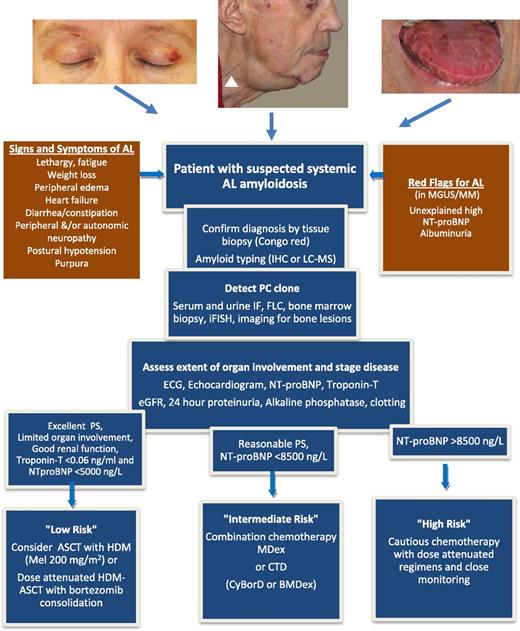 Figure 1. Pathway for a patient with suspected AL amyloidosis. Signs and symptoms derive from organ involvement: heart and kidney in 70% of patients each, liver in 17% of patients, soft tissues in 17% of patients, peripheral and autonomous nervous system in 15% of patients each, and gastrointestinal tract in 10% of patients. Clinical manifestations with head and neck purpura, unexplained submandibular swelling, signs of heart diastolic dysfunction such as jugular venous distention (white arrowhead), or stiff indented macroglossia, although found in no more than 15% of patients, are prototypic, but late manifestations of the disease. Symptoms and signs derive from advanced organ failure caused by the amyloid-forming process, whereas biomarkers of heart and kidney function (NT-proBNP and albuminuria) may allow identifying presymptomatic patients with initial, possibly reversible, amyloidotic organ damage. The diagnostic process involves the detection of the amyloid deposits and of the underlying PC clone. Considering the wide clinical heterogeneity of this disease, the assessment of the organ dysfunction is necessary in order to define the risk of chemotherapy. The flowchart represents the authors’ view on the current approach for management of a patient with AL amyloidosis. NT-proBNP cutoffs are not applicable in patients with end-stage renal failure. MDex represents the standard of care in most countries, and risk-adapted CTD is an alternative. Although increasingly used in clinical practice, the clinical benefit of adding bortezomib to dexamethasone and alkylating agents frontline remains unproven and is still being tested in controlled trials. ASCT with HMD, autologous stem cell transplantation with high-dose melphalan; BMDex, bortezomib, melphalan, dexamethasone; CTD, cyclophosphamide, thalidomide, dexamethasone; CyBorD, cyclophosphamide, bortezomib, dexamethasone; eGFR, estimated glomerular filtration rate; FLC, serum-free LC measurement; IF, immunofixation; iFISH, interphase fluorescence in situ hybridization; IHC, immunohistochemistry; LC-MS, laser capture microdissection and mass spectrometry; MDex, melphalan dexamethasone; MGUS/MM, monoclonal gammopathy of undetermined significance/multiple myeloma; NT-proBNP, amino-terminal pro–natriuretic peptide type-B; PS, performance status.