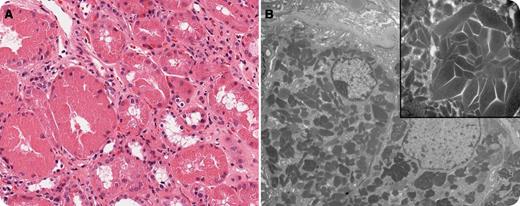 A 67-year-old man with an elevated creatinine (231 mmol/L) was found to have an elevated IgG monoclonal gammopathy. A renal biopsy identified light chain deposition. Routine staining by hematoxylin and eosin stain revealed acute tubular necrosis, with tubular dilatation, sloughing of the epithelial cells, loss of nuclei, and cytoplasmic fragmentation (panel A; original magnification ×400). On electron microscopy, there were the typical abundant needle-like crystalline materials in the tubular epithelial cells (panel B; original magnification ×1650, original inset magnification ×7300). Complete blood count at baseline revealed the following: white blood cells, 10.6 × 109/L; hemoglobin, 135 g/L; mean corpuscular volume, 90.6 fL; platelets, 233 × 109/L. Calcium, albumin, and a skeletal survey were normal. A bone marrow aspirate and biopsy confirmed an underlying diagnosis of multiple myeloma as the cause of renal light chain deposition. He was started on cyclophosphamide, bortezomib, and dexamethasone, followed by autologous stem cell transplant. / Light chain deposition disease is a rare type of plasma cell dyscrasia characterized by deposition of immunoglobulin fragments mostly involving the kidneys, but it may affect other organs such as the heart or liver. Concurrent multiple myeloma may be present in half of the cases. Renal biopsy often shows linear deposits of monoclonal light chains along the tubular basement membrane. Unlike amyloidosis, light chains in light chain deposition disease do not undergo conformational changes to form fibrils and do not have the ability to bind Congo Red.