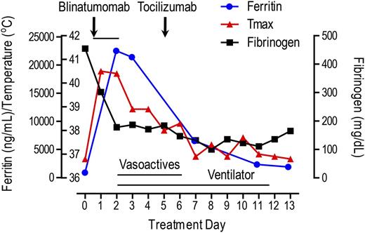 Figure 1. Clinical and laboratory parameters relative to timing of blinatumomab and tocilizumab. Serum ferritin and temperature rapidly rose and serum fibrinogen rapidly fell after starting blinatumomab. Poor systemic perfusion and respiratory failure continued to deteriorate after blinatumomab was stopped; however, these improved significantly after tocilizumab. Initiation of blinatumomab is depicted by arrow and total treatment duration depicted by black line. The blue line represents serum ferritin in ng/mL with circles showing tested values. Red line represents maximum temperature in centigrade (°C) per 24-hour period with triangles demarcating each day. The black line represents fibrinogen with squares depicting tested values. Horizontal axis = treatment days. Time on vasoactive medications (dopamine and epinephrine) is indicated by a black line under “vasoactives” (days 2 to 6). Time on ventilator is indicatedby a black line under “ventilator” (days 2 to 11).