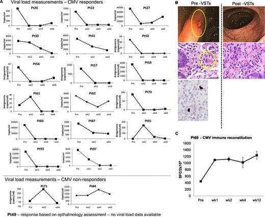 Figure 2. Outcomes after treatment with banked VSTs: CMV-infected patients. (A) Depiction of viral load measurements before and during 6 weeks postinfusion of VSTs in 19 evaluable patients (responders and nonresponders) treated for persistent CMV infection. Results are presented as copies per milliliter (CMV detected in blood) or as copies per cell in patients with CMV antigenemia. Because viral loads were measured by different assays at different institutions, interpatient comparisons should not be made. (B) An example of a patient with CMV colitis with evidence of viral inclusions on H&E staining that contained CMV by immunostaining (left panel). After VST infusion, there was a complete resolution of CMV colitis and no evidence of viral inclusions by H&E staining (right panel). (C) Frequency of CMVpp65–directed T cells in peripheral blood before and at weeks 1, 2, 4, and 12 postinfusion, as measured with an IFN-γ ELIspot assay after overnight stimulation of PBMCs with CMVpp65 pepmix. Results are expressed as mean (±SD) spot-forming cells (SFCs) per 2 × 105 input cells.