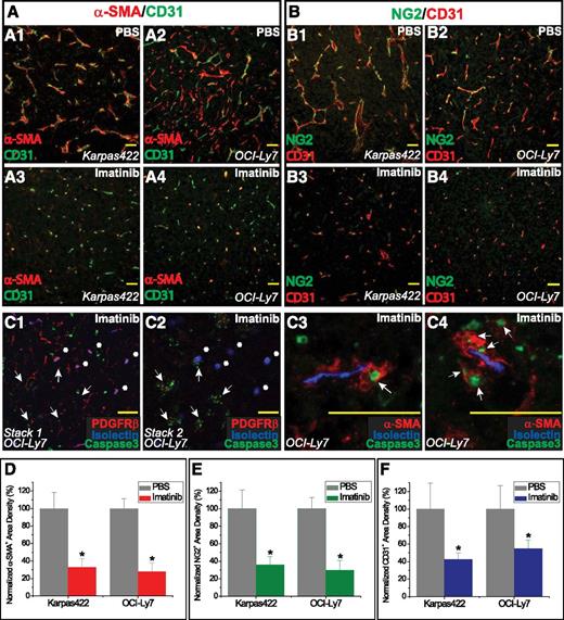 Figure 2. Imatinib treatment of human DLBCL tumors was associated with pericytic dropout and disruption of microvasculature. (A1-A4) Analysis of α-SMA+ pericytes and CD31+ vessels in (A1,A3) Karpas422 and (A2,A4) OCI-Ly7 xenografts. (B1-B4) Analysis of NG2+ pericytes and CD31+ vessels in (B1,B3) Karpas422 and (B2,B4) OCI-Ly7 xenografts. (C) Confocal analysis of pericytes (red) in relation to intraluminal blood flow (isolectin, blue) in OCI-Ly7 tumors. (C1-C2) Two z-stack images focused at different depths within the same tissue; white arrows indicate disrupted microvessels with scanty PDGFRβ+ staining and abundant cleaved-caspase 3+, apoptotic nuclei; white asterisks (*) indicate microvessels with relatively intact blood flow and perivascular PDGFRβ+ staining. (C3-C4) White arrows indicate apoptotic α-SMA+ pericytes surrounding regions of functional blood flow. (D) Pericyte coverage was quantified as α-SMA+ area (red) and normalized to the PBS control. (E) Pericyte coverage was quantified as NG2+ area (green) and normalized to the PBS control. (F) Microvessel density was quantified as CD31+ staining area (blue) and normalized to the PBS control. *P < .05 compared with control. Scale bar, 50 μm.