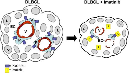 Schematic representation of antiangiogenic effects of imatinib on DLBCL. On the left, intact lymphoma vasculature is represented. On the right, in the presence of imatinib, PDGFRβ+ pericytes (P) are depleted via imatinib binding to the PDGFRβ receptor, leading to EC apoptosis, disruption of tumor vessel (V) integrity, and lymphoma (L) regression.