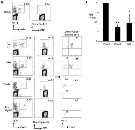 Figure 2. Changes in NKT cells. The presence of NKT cells was monitored by flow cytometry. PBMCs obtained from patients before starting therapy (PreC1), days 7 and 14 of cycle 1, before starting cycle 2 (PreC2), and at the completion of therapy (Post) were analyzed for the presence of iNKT cells using flow cytometry. The cells were stained with anti-CD3, Vα24, and Vβ11 antibodies. PBMCs were also analyzed using CD1d dimer either unloaded (Dimer control) or loaded with α-Galcer (Dimer Galcer). (A) Data from a representative patient during first cycle of therapy. (B) Summary of pooled data. Only patients with frequency of NKT cells above 0.01% at baseline were used to reliably estimate posttreatment decline in NKT cells. *P < .05; **P < .01.