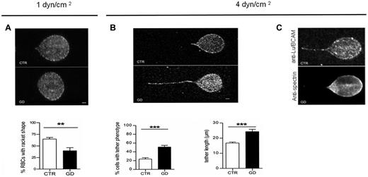 Figure 5. Confocal imaging of adherent GD and CTR RBCs to laminin α5 at different shear stresses. (A) Typical microscopic images showing the shape of adherent RBCs from 7 healthy CTRs and 7 GD patients at 1 dyn/cm2. The flow is from the left to the right. Lu/BCAM cell-surface expression was visualized by immunofluorescence using the monoclonal antibody F241 and confocal microscopy. Percentage of adherent RBCs with racket shape after inflow at 0.2 dyn/cm2 and increasing washout until 1dyn/cm2 was higher in CTR RBCs compared with GD RBCs (P < .01, Mann-Whitney test). (B) Same experiments as in panel A but with final washout at 4 dyn/cm2. GD RBCs frequently exhibited typical tether shape. Bars scales represent 1 μm. RBCs from GD patients exhibited more frequently a tether shape than CTR RBCs (***P < .0001). RBCs from GD patients exhibited longer tethers than CTR RBCs. Tether measurement was performed on 30 cells per condition (***P < .0004). (C) Same experiments as in panel B but GD RBCs were double-stained with anti-Lu/BCAM (top panel) or anti-spectrin (bottom panel) antibodies.