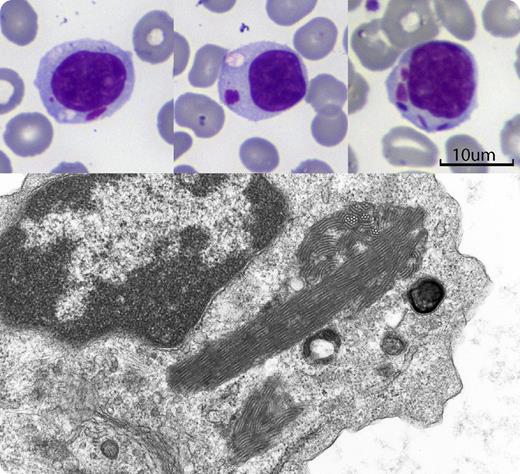 A 77-year-old man with seropositive rheumatoid arthritis was investigated for mild pancytopenia. He had mild splenomegaly, but no adenopathy. Hemoglobin was 117 g/L, platelets 126 × 109/L, and leukocytes 2.0 × 109/L with 96% lymphocytes, most of which were large granular lymphocytes (LGLs). Immunophenotyping showed an aberrant T-cell population co-expressing CD3, CD8, and CD57 with reduced expression of CD5, and absent CD56. T-cell receptor gene rearrangement confirmed a monoclonal T-cell population, consistent with T-LGL leukemia. After treatment with methotrexate lymphocytosis and splenomegaly resolved, but cytoplasmic inclusions remained. Approximately 40% of lymphocytes contained cytoplasmic inclusions, either single or multiple, and in some cells the inclusions were associated with a cytoplasmic vacuole (see figure). The inclusions had a color resembling that of nuclear chromatin, with variable shapes ranging from round to rod-like. Electron microscopy showed them as giant parallel tubular arrays (PTAs) consisting of dense bundles of thick-walled tubules with a diameter of approximately 30 nm. / First recognized more than 40 years ago, the function of these structures is unclear. PTAs can be found in infectious mononucleosis, and rarely in chronic lymphocytic leukemia and in healthy individuals. Most often they are seen in systemic immunologic disorders (eg, systemic lupus erythematosus, rheumatoid arthritis, HIV infection), all of which can be associated with reactive or clonal proliferation of T-LGLs.