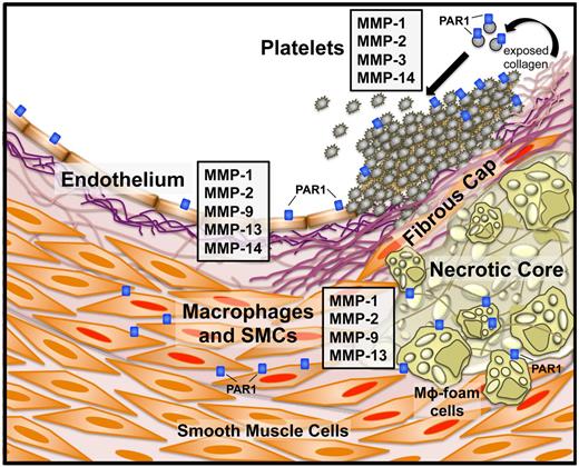 Figure 3. MMP and PAR1 expression in atherothrombotic disease. Specific MMPs and PAR1 and their cellular sources in an atherosclerotic blood vessel. Instability of the fibrous cap overlaying the plaque can lead to subendothelial collagen exposure and subsequent platelet activation. Platelets express MMP-1, -2, -3, and -1413,60,61 and exposure of naive platelets to collagen activates MMP-1 from the proMMP1 zymogen. Endothelial cells express a number of MMPs, including MMP-1, -2, -9, -13, and -14.18 Macrophages and smooth muscle cells (SMCs) are activated (Mφ foam cells and SMCs with red nuclei) by the proinflammatory state resulting from cholesterol deposition in the plaque body and secrete MMP-1, -2,-9, and -13, among others.18,26