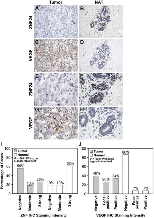 Figure 5. ZNF24 levels and VEGF levels are inversely correlated in human breast cancer tissues compared with normal adjacent tissues. (A-H) Serial sections of human breast cancer TMAs containing malignant and normal adjacent tissues were stained with ZNF24 Ab (A,B,E,F) or VEGF Ab (C,D,G,H). Representative images of normal adjacent tissues and tumor tissues at 400× (A-D) and at 1000× (E-H) are shown. Histograms depict the percentages of patients demonstrating negative, moderate, or strong staining of ZNF24 (I) and negative, focal positive, or positive staining of VEGF (J). A higher percentage of negative ZNF24 staining was observed in tumors (median = negative staining) versus a higher percentage of positive staining in normal tissues (median = strong). A higher percentage of positive VEGF staining was observed in tumors (median = focal positive staining) versus a higher percentage of negative staining in normal tissues (median = negative staining). Images were obtained at room temperature using an Olympus BX41 microscope equipped with a 40×/0.75 objective and an 100×/1.30 oil-immersion objective (Olympus), Olympus Q-color5 digital camera (Olympus) and Adobe CS4 V.11 software (Adobe).