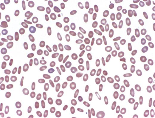 A 75-year-old man with a 5-year history of myelodysplastic syndrome (MDS) subsequently developed worsening fatigue, dizziness, and dyspnea on exertion. There was no family history of hematologic diseases. On examination he was cachectic with no hepatosplenomegaly and petechiae, but purpuric lesions were present on his hands. The complete blood count showed pancytopenia (hemoglobin 10.2 g/dL, white blood cell count 2.8 k/uL, absolute neutrophil count 1.6 k/uL, platelets 23 k/uL) with a mean corpuscular volume of 101.3 fL. Reticulocyte count was not performed. The peripheral smear showed striking elliptocytosis (see figure). Bone marrow biopsy revealed hypercellularity with prominent megakaryocytic and granulocytic dysplastic. Conventional cytogenetic analysis detected a del(20)(q11.2) with a sideline showing a marker chromosome. The earlier hematologic assessment 5 years prior showed an isolated del(20q)(q11.2) with no evidence of elliptocytosis. / Acquired elliptocytosis may be seen in a variety of bone marrow disorders, including architectural disturbances such as fibrosis and myelophthisis. It can also be a manifestation of dysplastic erythropoiesis in the setting of MDS. Acquired elliptocytosis is generally characterized by fewer elliptocytes (< 15% of total red blood cells) than the marked numbers seen in hereditary elliptocytosis (HE). Reports suggest an association between marked elliptocytosis in MDS and del(20q) that was seen in this patient. Diminished production of protein 4.1 (EBP41), a structural RBC protein implicated in some cases of HE, has also been demonstrated in MDS with elliptocytosis. An interesting feature of this case was the acquisition of elliptocytosis as the disease progressed.