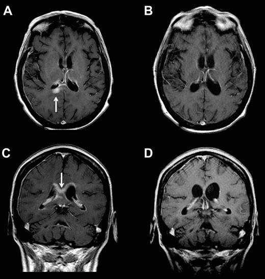 Figure 3. Example of parenchymal response in a patient with refractory CNS lymphoma who was treated with intraventricular rituximab at 25 mg plus MTX. Panels A and C are baseline; panels B and D are after 4 weeks of therapy.