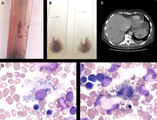 A 60-year-old man was hospitalized for weakness, back pain, and respiratory distress. Multiple lymph nodes, liver, and spleen enlargements were palpable. Blood cell count findings were hemoglobin 9.4 g/dL, white blood cells 7.910 × 109/L, and platelets 6 × 109/L. Peripheral blood film observation revealed leuco-erythroblastosis. A bone marrow aspiration yielded a viscous mixture with brownish clumps (see figure panel A) leading to dark smears (panel B). The marrow was heavily infiltrated by noncohesive tumor cells, and the cytoplasm contained heterogeneous dark brown granules (panel D). Numerous background macrophages also showed cytoplasmic pigmentation (melanophages, panel E). Bone marrow biopsy immunochemistry was positive for Melan A. A dorsal melanoma was found, as well as widespread vertebral, liver, and spleen metastases (panel C). Despite intensive care the patient died. / Metastatic melanoma involving the bone marrow is rare, occurring in 5% of patients with disseminated disease but in up to 45% when an autopsy-staging procedure is performed. Dark pigments are highly suggestive of melanoma cells and are often found in the associated macrophages. Although the diagnosis should be relatively straightforward, the nature of the pigment should be confirmed using melanoma-associated MART-1 gene product (Melan A, A 103 antibody) or melanosome matrix protein gp 100 (HMB 45 antibody).