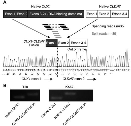 Figure 4. The CUX1 gene on 7q22 is disrupted by a fusion event involving CLDN7 on 17p13.1 resulting in a chimeric transcript in 1 sample. (A) Model of the chimeric fusion transcript. The fusion contains the first exon of CUX1 upstream of exons 2-4 of CLDN7. The fusion was identified by 35 RNA-sequencing reads wherein one end of the paired-end reads maps to one gene whereas the mate-pair maps to the other gene (indicated by black bars connected by hyphenated lines). In addition, 89 junction spanning reads (indicated as single bars) were identified that map across the exon-exon boundaries of the fused genes. Sanger sequencing of the PCR product confirmed the fusion. The CLDN7 exons are out of frame with respect to the CUX1 start site, resulting in a premature stop codon. (B) RT-PCR of RNA from t-MN sample T20 confirms the presence of both the CUX1-CLDN7 fusion transcript and native CUX1. K562 cells, which express both endogenous CUX1 and CLDN7, but not the fusion transcript, were used as a control.
