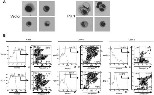 Figure 4. PU.1 induces apoptosis in primary cHL cells from patients. (A) Morphology of purified, primary cHL cells transduced with control lentivirus (Case 1, 4 left panels) or PU.1 expressing lentivirus (Case 1, 4 right panels). A number of primary classic Hodgkin cells expressing PU.1 contained various-sized vacuoles Images were acquired using a BX60 microscope and DP70 digital camera with DP controller software (Olympus; ×1000 magnification). (B) Primary cHL cells transduced with PU.1 lentivirus tended to undergo apoptosis compared with cells transduced with empty vector. Apoptosis was assessed in Venus-positive cells by flow cytometry after staining with PI and allophycocyanin-conjugated annexin V. Stable transduction of primary cHL cells from case 1 with PU.1 lentivirus led to a decrease in the percentage of live PI−/annexin V− cells and an increased percentage of PI−/annexin V+ preapoptotic cells, compared with control vector. Stable transduction of primary cHL cells from case 2 with PU.1 lentivirus also led to a decrease in the percentage of live PI−/annexin V− cells and an increased percentage of PI+ apoptotic cells. Stable transduction of primary cHL cells from case 3 with PU.1 lentivirus also led to a decrease in the percentage of live PI−/annexin V+ cells and an increased percentage of PI+ apoptotic cells.